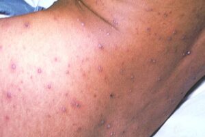 Chickenpox stage 3