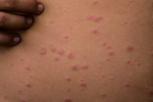 Boy who has chickenpox The symptoms are red bumps full body.