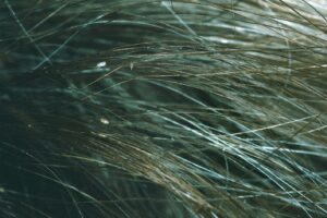 Nits (head lice eggs) in hair