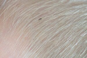 Image of head lice in hair